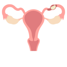 illustration of an ectopic pregnancy in the fallopian tubes
